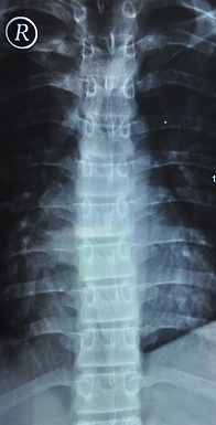 Wirbelsäulen-Röntgen